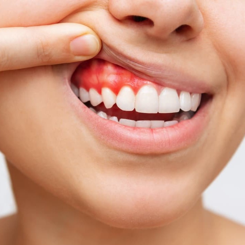 Bleeding gums treatment in Sahakara Nagar, expert gum treatment in Bangalore, gum diseases treatment in Sahakara Nagar, gum specialist in Sahakara Nagar, gum therapy treatment in Sahakara Nagar, teeth scaling in Sahakara Nagar, treatment for bleeding gums in Sahakara Nagar
