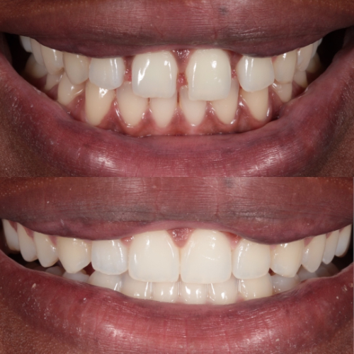 Dental Bonding, dental bonding in sahakara nagar, dental bonding treatment in sahakarnagar, teeth bonding in sahakarnagar, teeth bonding treatment in sahakarnagar