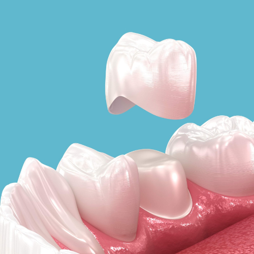 Dental Crowns And Bridges, dental crown fixing services in sahakara nagar, dental crowns and bridges in sahakarnagar, dental crowns cost in sahakara nagar, dental crowns treatment in sahakarnagar, porcelain crowns sahakarnagar